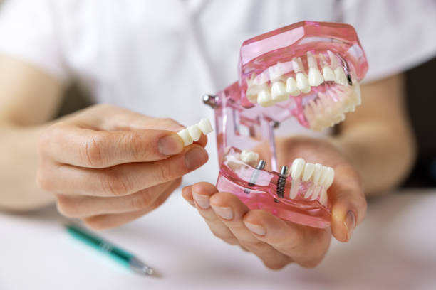 zahnimplantatologe zeigt zahnbrückenimplantat-technologie auf menschlichem zahnkiefermodell - zahnimplantat stock-fotos und bilder