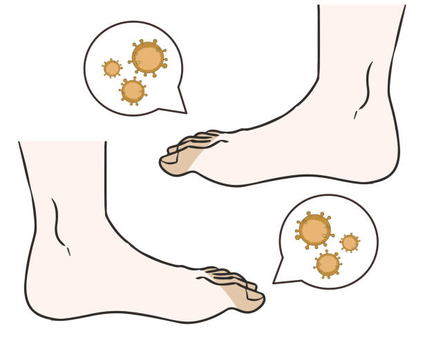Foot white bacteria side Created with Illustrator & CLIP STUDIO PAINT. tinea stock illustrations