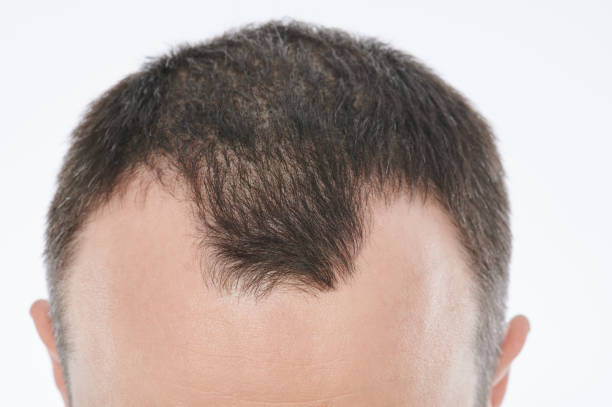 istock Hairloss in young age theme 1289770334