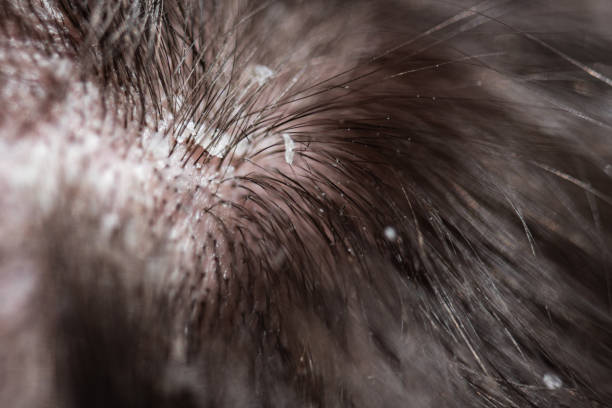 проблемы с волосами dandruff молодого человека - dry skin close up horizontal macro стоковые фото и изображения