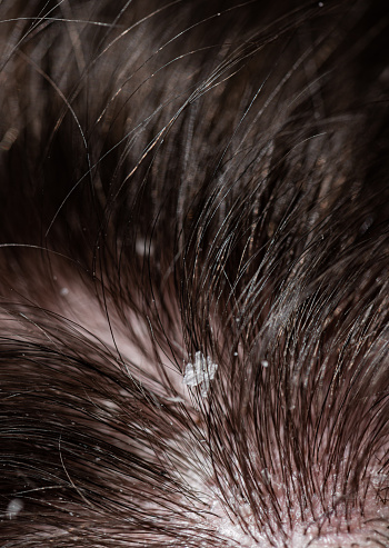 Dandruff Hair Problems of a Young Man shot with a macro