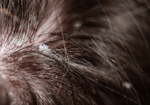 Dandruff Hair Problems of a Young Man shot with a macro