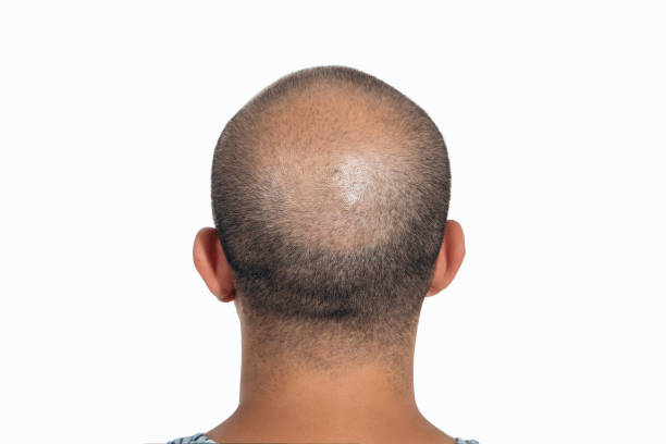 istock Back of the young man's bald head 1289788658