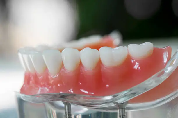Photo of Teeth model showing an implant crown bridge model.