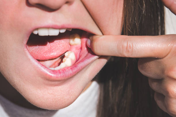 young woman showing mouth without tooth on lower jaw. missing tooth. waiting an implant after tooth extraction - toothless grin imagens e fotografias de stock