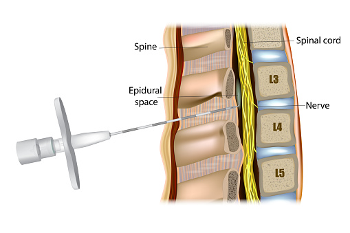 Epidural administration or Epidural anesthesia. Medicine is injected into the epidural space around the spinal cord. Tuohy Epidural Needle.