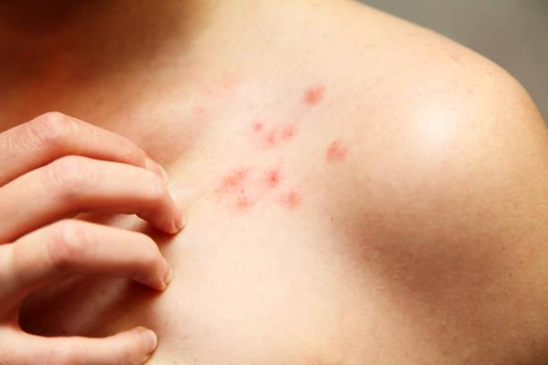 istock Allergy concept. Woman scratching her shoulder with rash on white background 1290152576