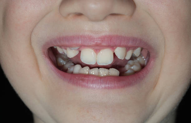 istock Smile of a boy with teeth growth defects. 1290560494