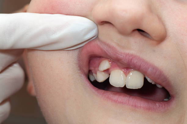 kieferorthopädie untersucht jungen mund. der zahn wächst an der falschen stelle. - fehlbiss stock-fotos und bilder