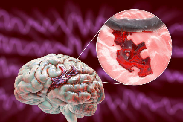 Hemorrhagic stroke, illustration Hemorrhagic stroke, 3D illustration showing hemorrhage on the brain surface and closeup view of the bleeding from a brain blood vessel infected wound stock pictures, royalty-free photos & images