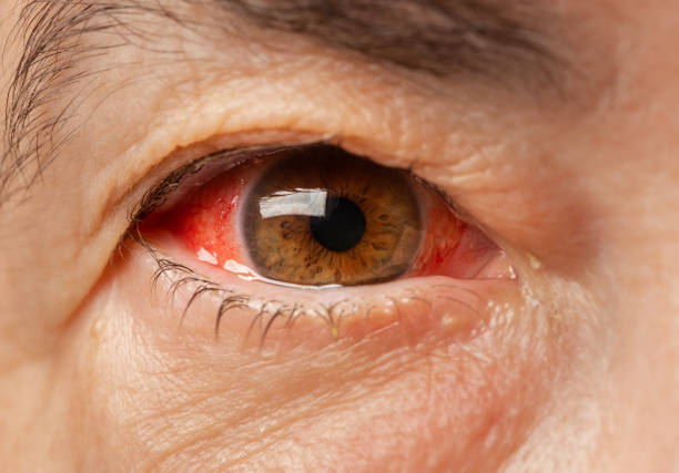 close-up de um olho de sangue vermelho irritado de mulheres adultas maduras afetadas por conjuntivite ou após gripe, resfriado ou alergia - blood disease - fotografias e filmes do acervo