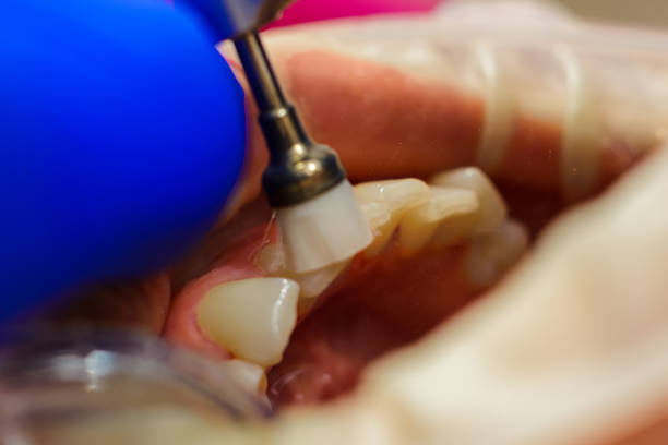 istock The dentist polishes the teeth with a drill, a dental procedure. 1290992948