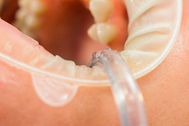 istock The dentist polishes the teeth with a drill, a dental procedure. 1290993043