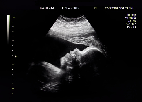 2D pregnancy ultrasound of a baby at 30 weeks