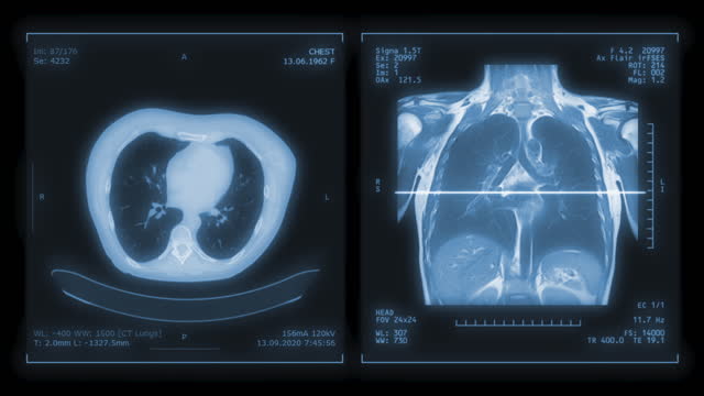 CT Chest or CT Scan of Human Chest Coronal MIP View with Lung filter technique for diagnosis TB,tuberculosis and covid-19 .