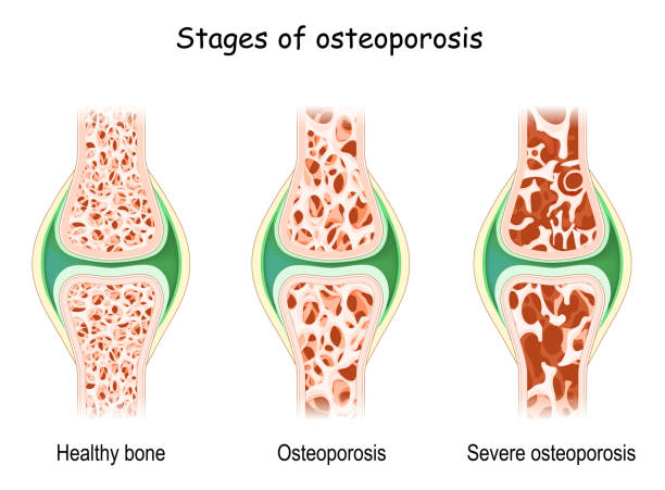 osteoporose-stadien. schwere osteoporose - osteoporose stock-grafiken, -clipart, -cartoons und -symbole
