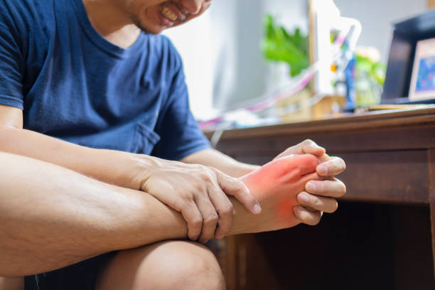Man with painful and inflamed gout stock photo