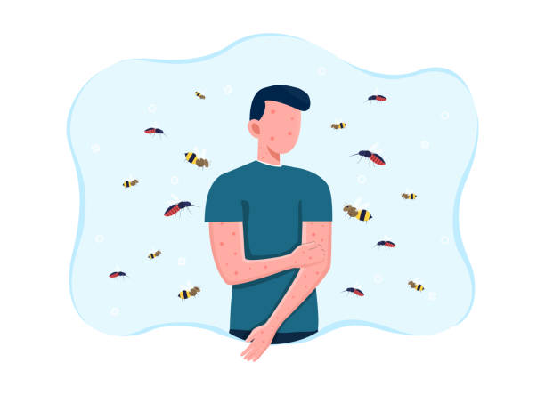 Man suffering from bee allergy Man suffering from bee allergy. Red and itchy skin. Allergic skin reaction to bees and wasps flying around and stinging. Flat cartoon vector illustration stinging stock illustrations