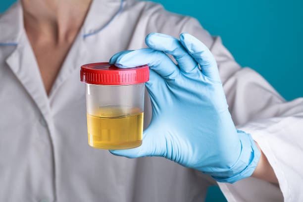 un médico con una bata blanca y guantes azules sostiene una lata de plástico de orina en la mano. virus de pruebas de orina, embarazo, enfermedades - orina fotografías e imágenes de stock