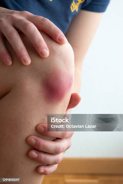 Kneeled Knelt Down Caucasian Young Woman Tenting To Her Bruised Knee Lose Up Shot Unrecognizable Stock Photo - Download Image Now