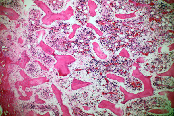 microscopio de carcinoma quístico adenoides, tipo raro de cáncer existen en muchos sitios diferentes del cuerpo. este tumor se produce en las glándulas salivales, con lente macro 40x de cerca, concepto de laboratorio de microbiología. - salivary gland fotografías e imágenes de stock