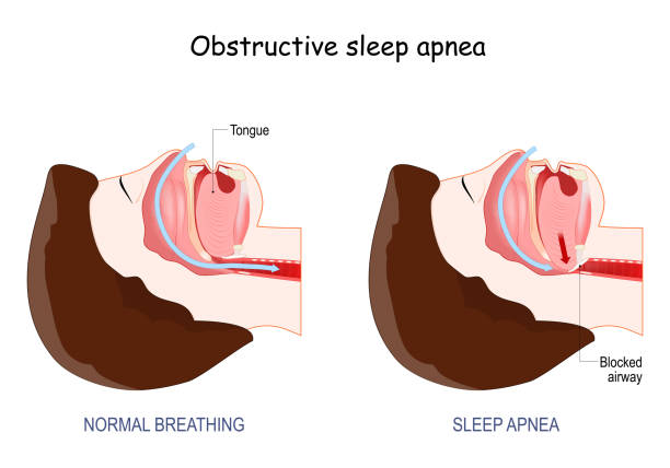 439 Sleep Apnea Illustrations & Clip Art - iStock | Sleep, Snoring, Sleep  apnea mask