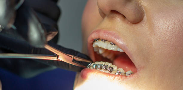 istock A woman at a dentist's appointment to replace arches with braces. 1292068559