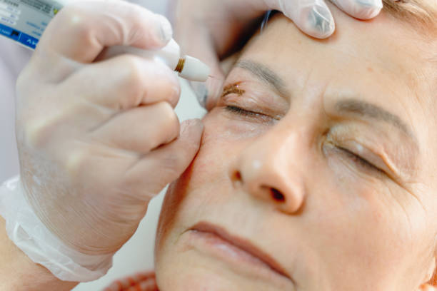 istock Cystic lesions, hyperpigmentation, palpebral ptosis, palpebrarum, plexr device, xanthelasma, blepharoplasty 1292118546