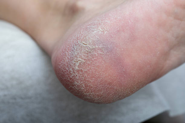 istock Sore heel with dry skin and cracks. 1292134396