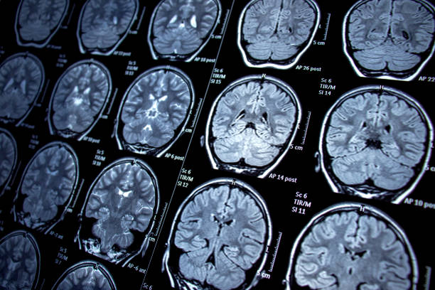 자기 공명 화상 진찰 - mri - 감광성 간질 / 포착 - 신경학상 질병 - 인간 신경계 뉴스 사진 이미지