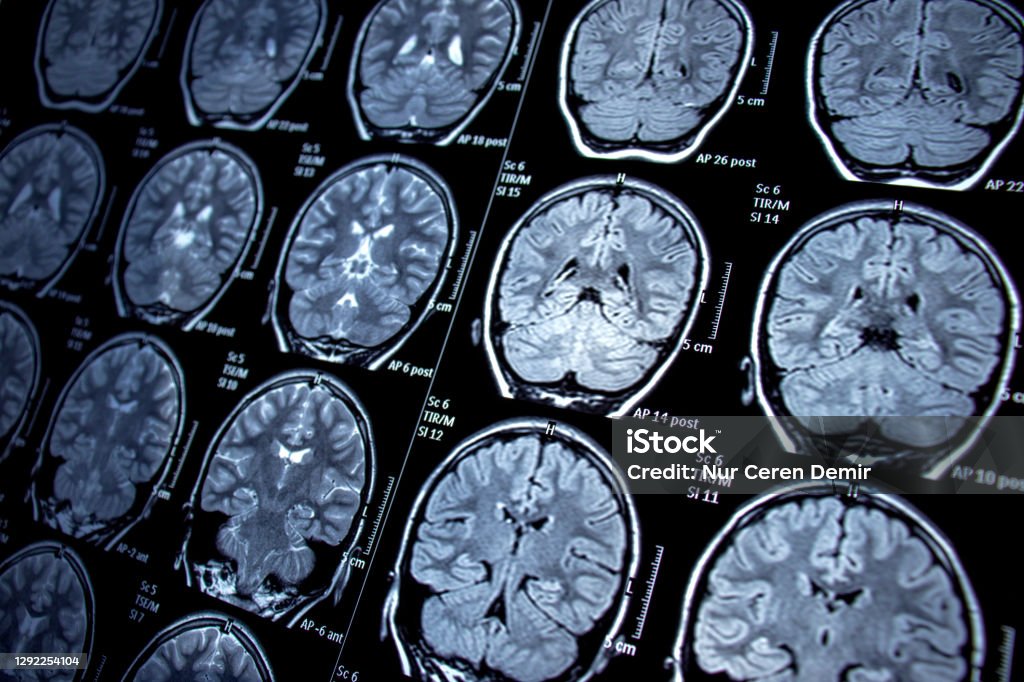 Magnetic resonance imaging - MRI - Photosensitive Epilepsy /  Seizures - Neurological Diseases neurology, epilepsy, magnetic resonance imaging, mri, seizure, health MRI Scan Stock Photo