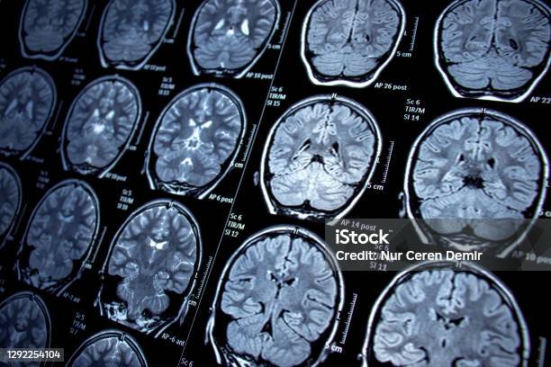 Magnetic Resonance Imaging Mri Photosensitive Epilepsy Seizures Neurological Diseases Stock Photo - Download Image Now