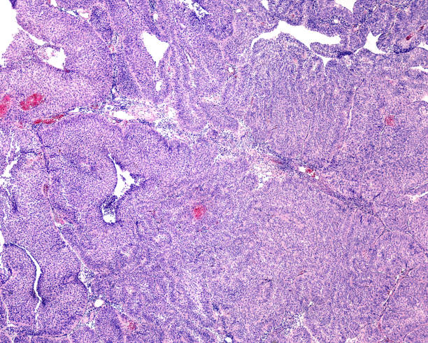 Urinary bladder papiloma Microscopic image showing a urinary bladder papilloma formed by papillae with fibrovascular core and coated with transitional (urothelial) epithelium. Light microscope micrograph. H&E stain urothelium stock pictures, royalty-free photos & images