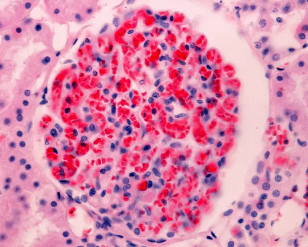 Photo of Kidney. Glomerular congestion