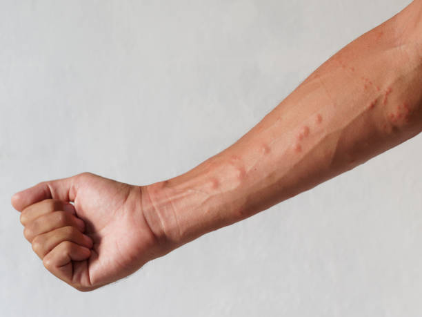 istock Skin rash, rashes caused by allergic reactions on arms. 1292497345