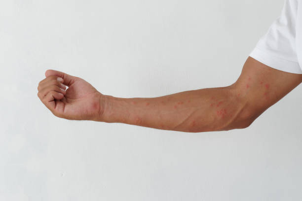 istock Skin rash, rashes caused by allergic reactions on arms. 1292497349