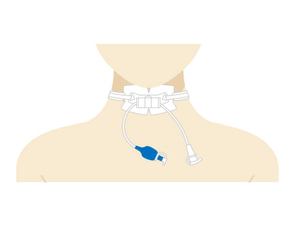 Tracheostomy Illustrations that can be used in various fields tracheotomy tubing stock illustrations