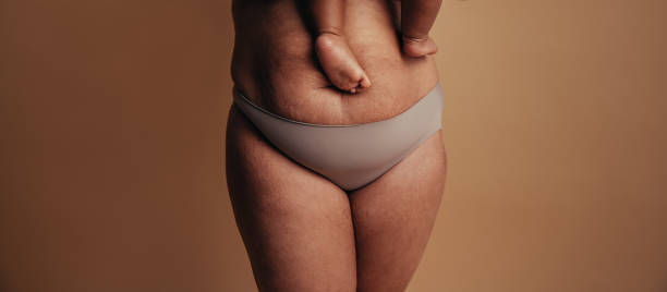 Postpartum belly after baby