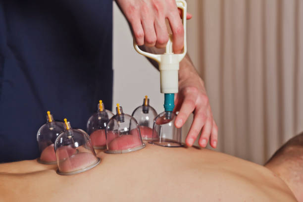 Close-up for multiple vacuum cups, medical cupping therapy on human body Close-up for multiple vacuum cups, medical cupping therapy on human body. Doctor with cups for patient, therapy. Wellness, health injury rehabilitation concept. Alternative medicine. Copy space cupping therapy stock pictures, royalty-free photos & images