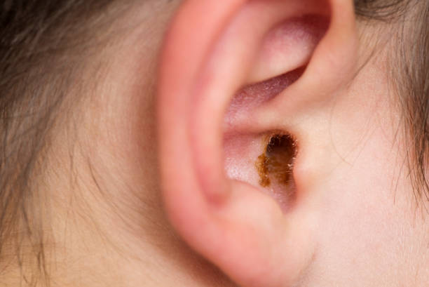 Earwax in the dirty ear of a child. Hole ear of human, wax on hair and skin of ear. Earwax in the dirty ear of a child. Hole ear of human, wax on hair and skin of ear. ear canal stock pictures, royalty-free photos & images