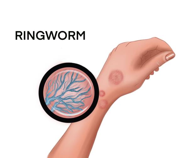 Illustration of the ringworm on the hand Medicine Illustration of the ringworm on the hand tinea stock illustrations