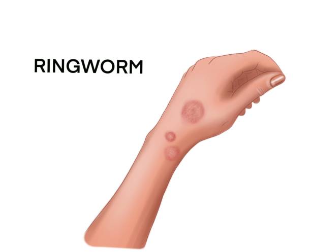 Illustration of the ringworm on the hand Medicine Illustration of the ringworm on the hand tinea stock illustrations