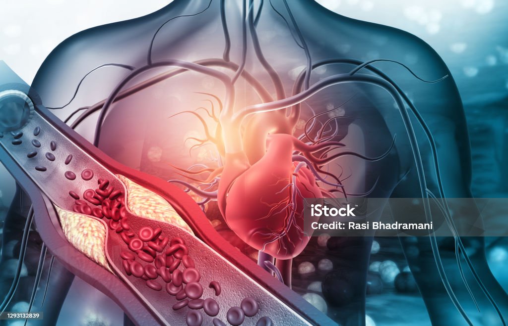 Human heart with blocked arteries Human heart with blocked arteries. 3d illustration Heart - Internal Organ Stock Photo