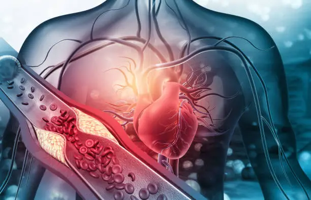 Human heart with blocked arteries. 3d illustration