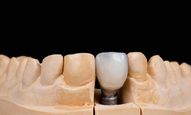 istock 1 unit press ceramic crown on implant 1293278161