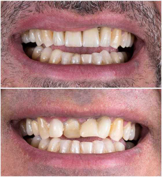 istock before and after picture for frontal teeth dental tratment by ceramic bridge 1293278295