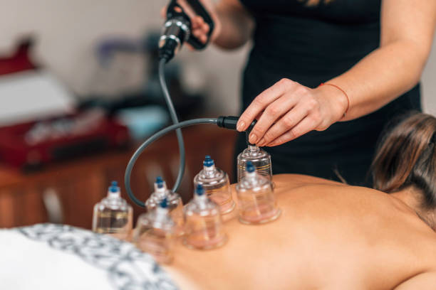istock Vacuum Therapy. Therapist Placing Transparent Glass Cups on Woman's Back 1293353272