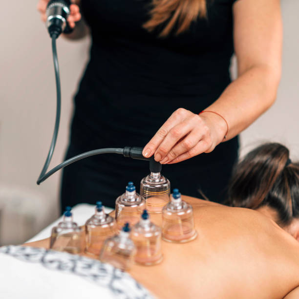 istock Vacuum Therapy. Therapist Placing Transparent Glass Cups on Woman's Back 1293353510