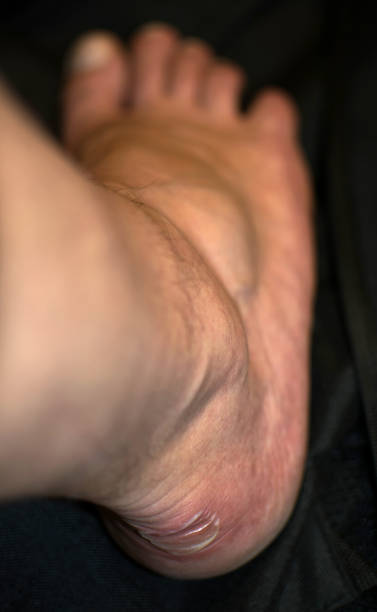 istock Blister caused by shoes. 1293400570