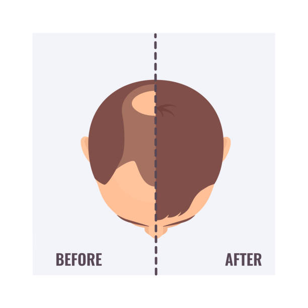 ilustrações, clipart, desenhos animados e ícones de homem careca antes e depois do transplante capilar - alopecia antes depois